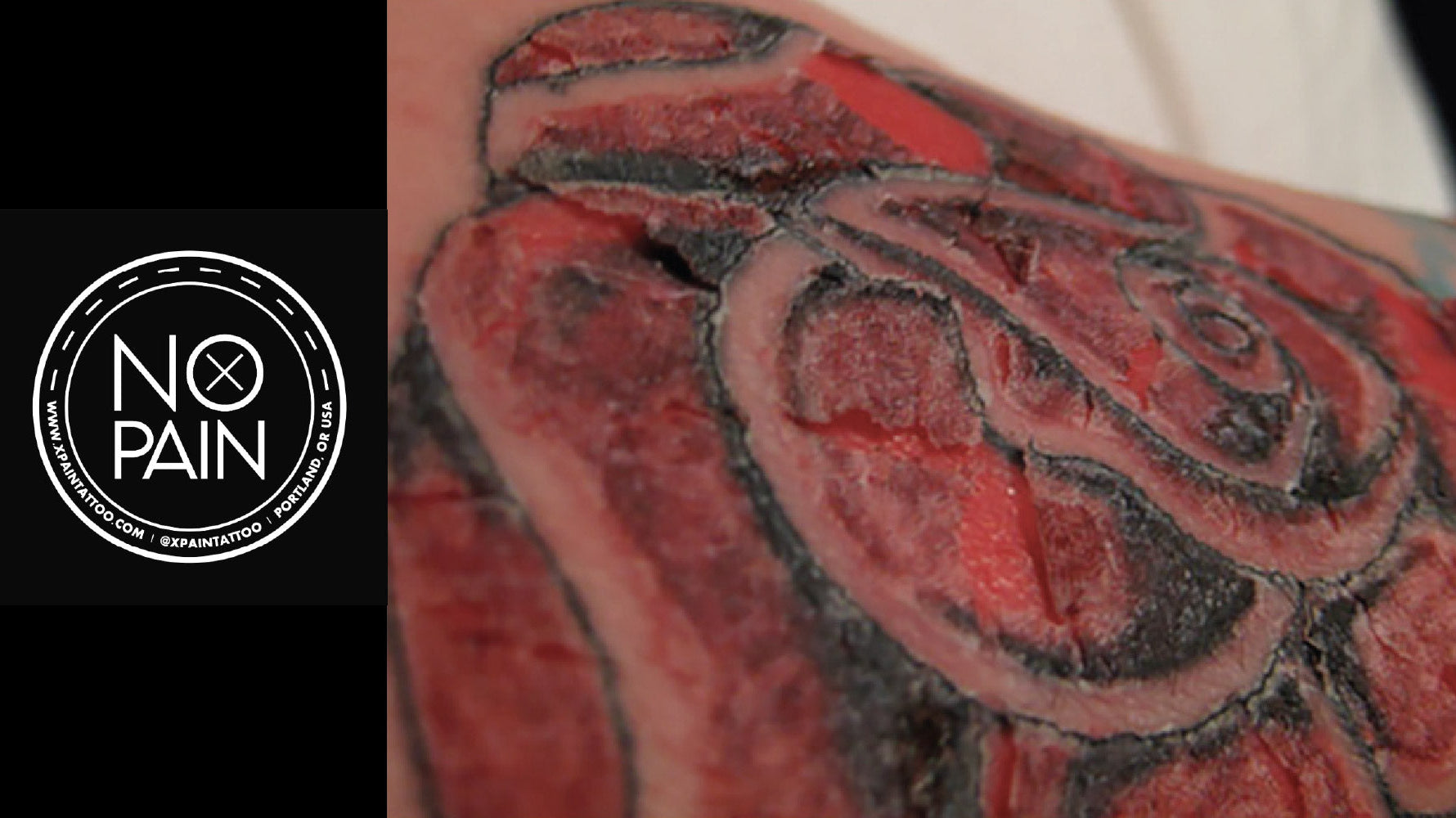 What to Do if You Have an Allergic Reaction to Tattoo Ink: A Safety Guide