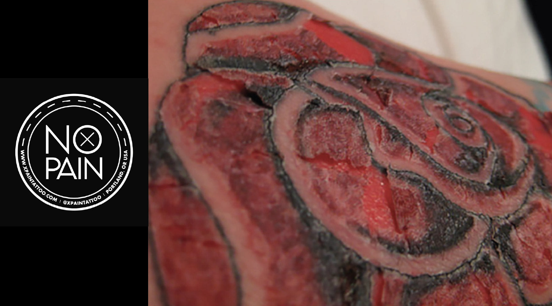 What to Do if You Have an Allergic Reaction to Tattoo Ink: A Safety Guide